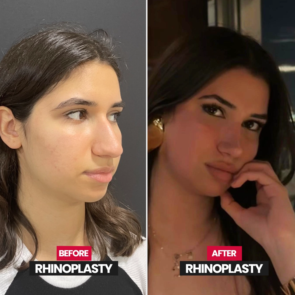 Natural rhinoplasty result