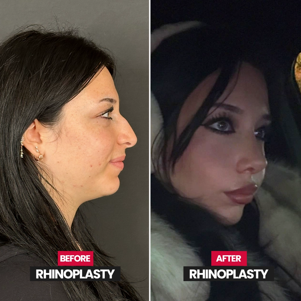Ethnic rhinoplasty result
