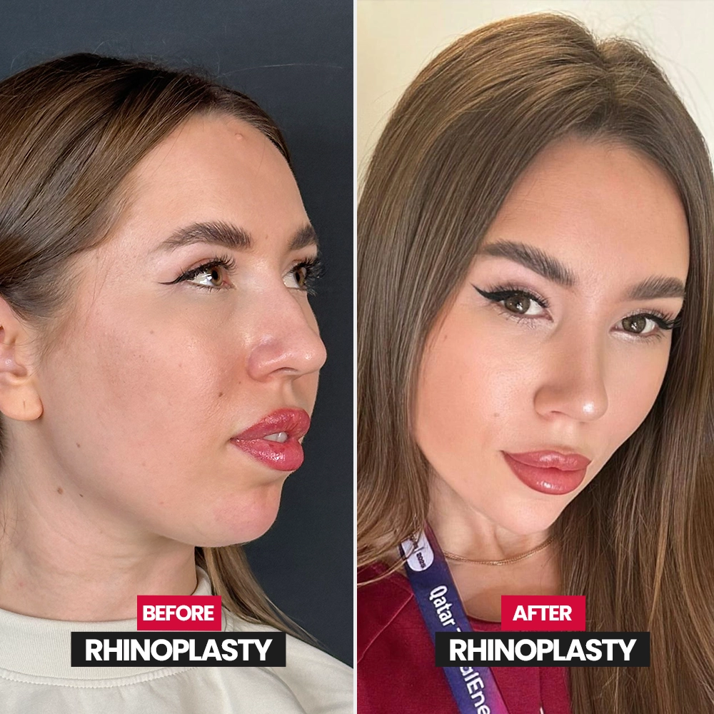 Revision rhinoplasty result
