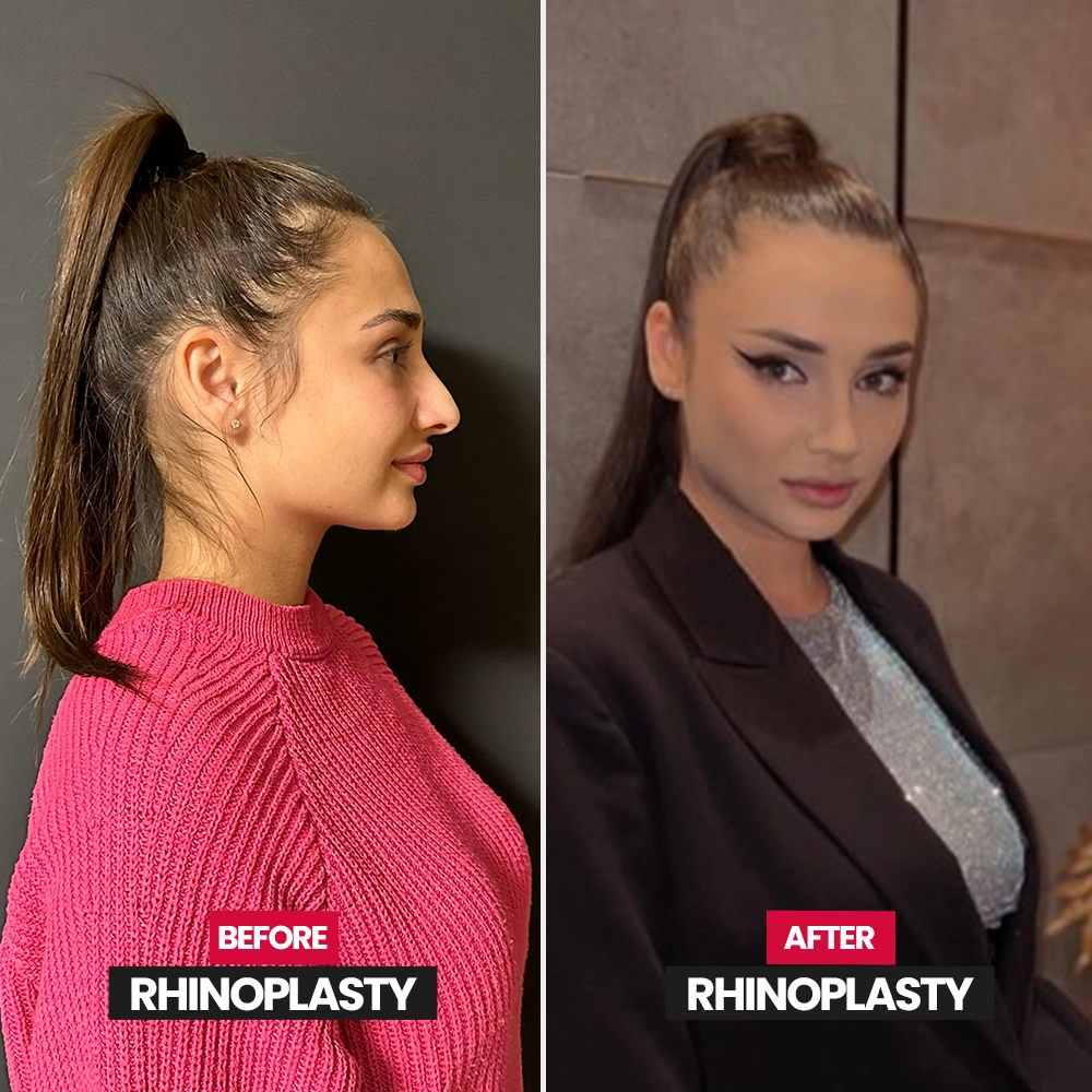 Natural rhinoplasty result