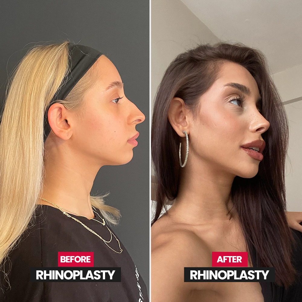 Natural rhinoplasty result
