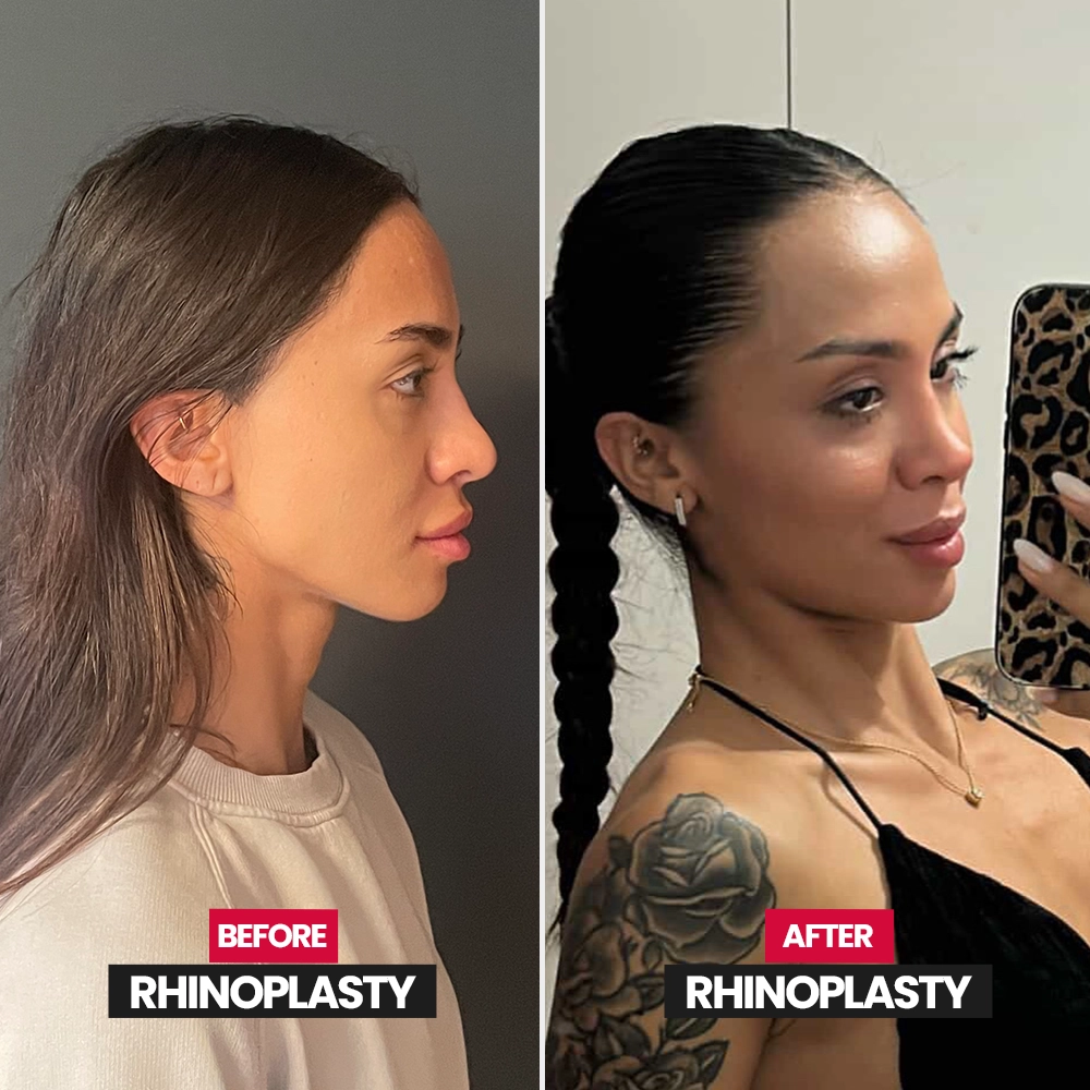 Revision rhinoplasty result