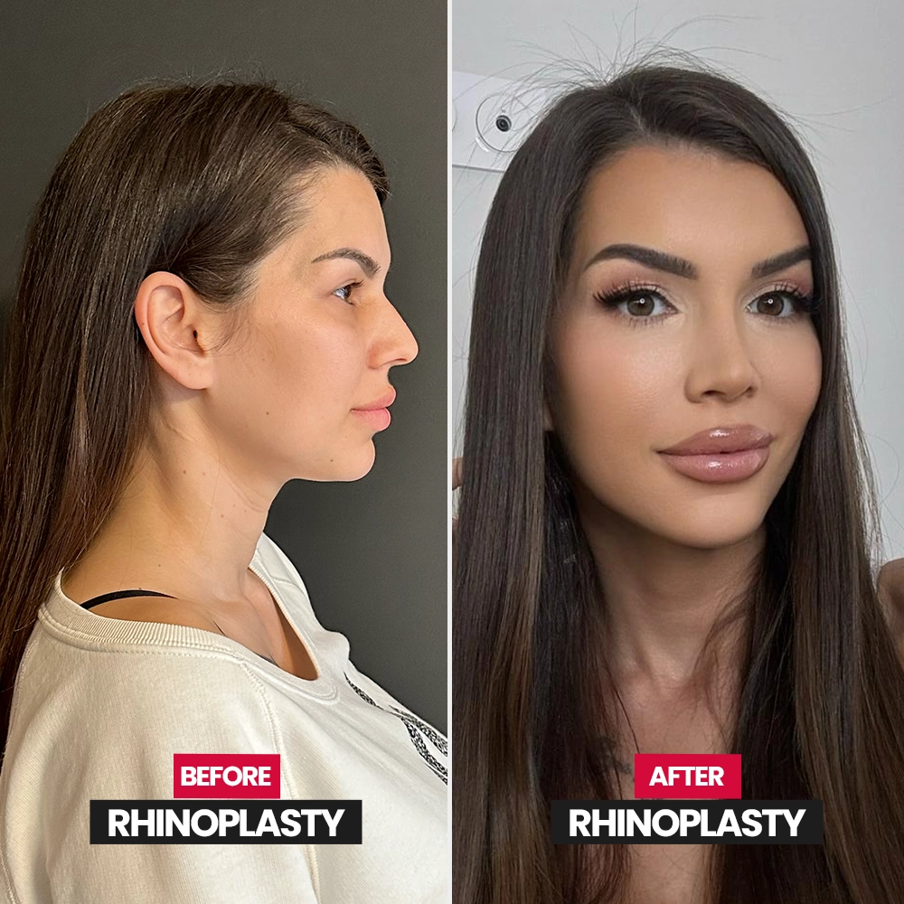 Ethnic rhinoplasty result